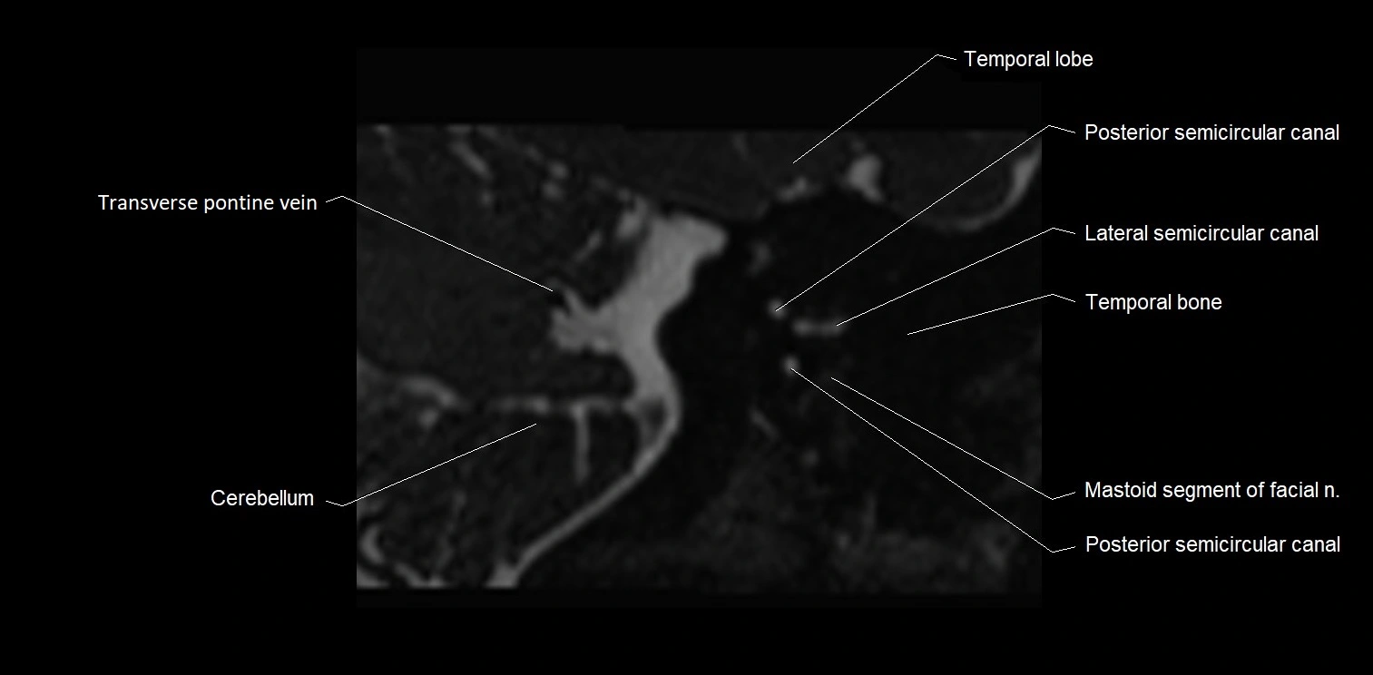 MRI Internal auditory meatus (IAM) coronal cross sectional labelled anatomy image 28.webp
